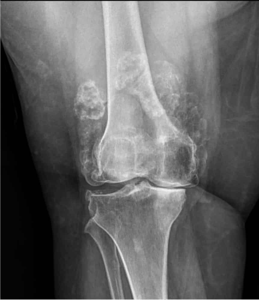 Severe Osteoporosis X Ray