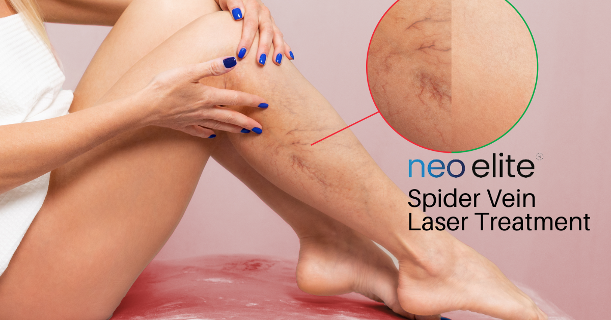 Neo Elite Laser treatment for Spider Veins